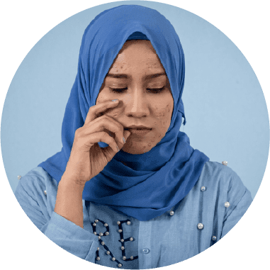 Cara Cepat Samarkan Dark Spot Saat Memasuki Usia 25 Tahun