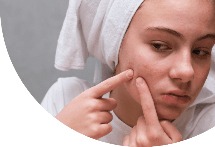 Komedo? Simak Penyebab, Jenis-Jenis Komedo dan Cara Mengatasinya!