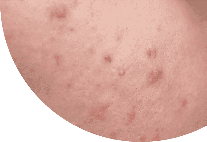 Bagaimana Sebum Berlebih Memicu Jerawat dan Cara Mengendalikannya