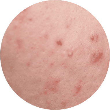 Bagaimana Sebum Berlebih Memicu Jerawat dan Cara Mengendalikannya